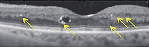 Figure 4. It has been suggested that hyperreflective retinal spots, also referred to as hyperreflective foci, seen on OCT, which are shown here appearing in the middle and outer retina, may be biomarkers of ongoing inflammation.5,16 
Source: Midena E, Pilotto E. Emerging Insights into Pathogenesis. Dev Ophthalmol. 2017;60:16-27. doi: 10.1159/000459687. Epub 2017 Apr 20.