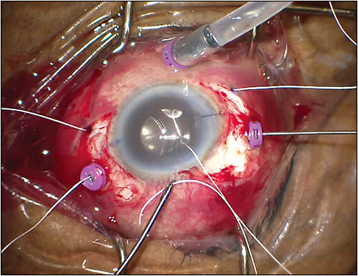 Figure 2.  Anterior-chamber hand-to-hand technique during Gore-Tex scleral fixation of an intraocular lens. In a hand-to-hand technique, Gore-Tex suture is passed from the MST grasping forceps (Microsurgical Technology) via a clear corneal incision to a 25-gauge Grieshaber Maxgrip forceps (Alcon) in the posterior chamber. A dispersive ophthalmic viscoelastic device was utilized to protect the corneal endothelium prior to intraocular lens placement into the anterior chamber.