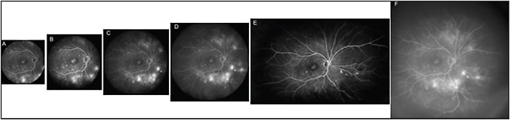 Figure 2. Fluorescein angiography images of a patient with proliferative diabetic retinopathy: 30° (A), 55° (B), and 60° with Ocular Lee-Mainster SLO Lens (C); 102° with the Ocular Staurenghi contact lens (D), 120° on horizontal axis and 80° on vertical axis with Optos imaging system (E); and 150° with the Ocular Staurenghi contact lens (F).