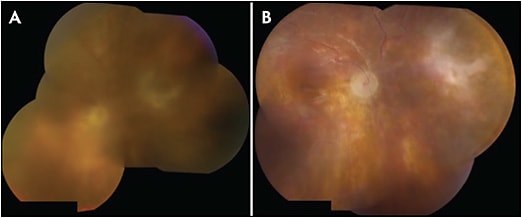 Figure 2. Fundus photos of a patient with diffuse toxoplasmosis chorioretinitis who developed a total retinal detachment with a large atrophic hole superonasal to the optic nerve (A). Following pars plana vitrectomy, endolaser, and silicone oil instillation, retinal reattachment was achieved but the VA remained poor due to optic atrophy and macula-off retinal detachment status (B).