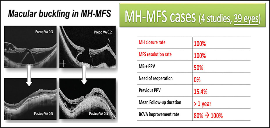 Figure 3. MB in MH-MFS: 2 cases of MH and associated foveoschisis that underwent MB (left). Anatomical and functional results included in the review, as cited in the text (right).