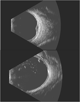 Figure 1. Choroidal melanoma in the left eye using the Ellex Eye Prime posterior 18 MHz probe (A) and retinal tear with anterior vitreous opacities in the left eye using the Ellex Eye Prime posterior 18 MHz probe (B).
IMAGE COURTESY OF ELLEX