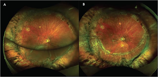 Figure 1. A patient underwent 2 surgeries for retinal detachment prior to referral. The first surgery was a vitrectomy with gas placement and the second was a scleral buckle, vitrectomy, and silicone oil placement. There was a silicone oil underfill with subsequent inferior proliferative vitreoretinopathy posterior to the buckle edge and redetachment (A). A vitrectomy, inferior retinectomy, and silicone oil placement was then performed, and the retina remained attached (B). Images courtesy of Xi Chen, MD, PhD.
