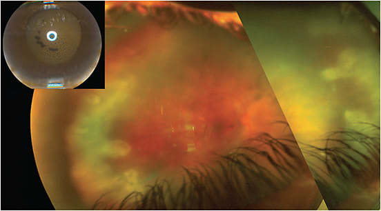 Figure 1: This patient had a 2-week history of iritis treated with topical steroids. The iritis was improving, but the vision was still 20/200. A dilated exam revealed vitritis and a large area of peripheral retinitis consistent with a diagnosis of acute retinal necrosis.