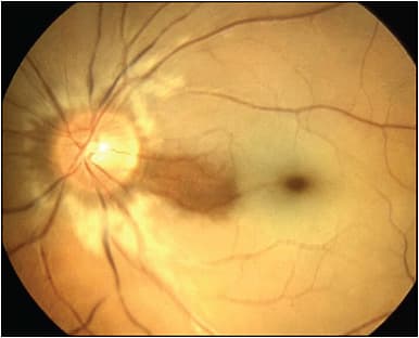 Figure 3. Central retinal artery occlusion (CRAO) with cilioretinal artery sparing. This patient has dense vision loss in the left eye due to an embolic CRAO except in the temporal paracentral visual field: &amp;#x201C;sparing&amp;#x201D; of the retinal ischemia (intact perfusion) from a cilioretinal artery in the nasal macular region preserves the temporal visual field in that eye.