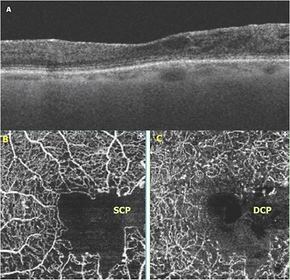 Figure 1. Spectral domain OCT B-scan (A) of a 74-year-old patient with diabetic retinopathy with evidence of disorganization of the retinal inner layers (DRIL). Note that to the right of the foveal center adjacent to the cystoid spaces, there is poor delineation of the retinal layers consistent with DRIL. OCT angiography of the macula shows extensive capillary nonperfusion in both the superficial capillary plexus (B) and deep capillary plexus (C).