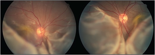 Figure 1. Bullous retinal detachment in both eyes in patient 4, a 44-year-old Asian female with protein-losing enteropathy. Her visual acuity was 20/400 in both eyes.