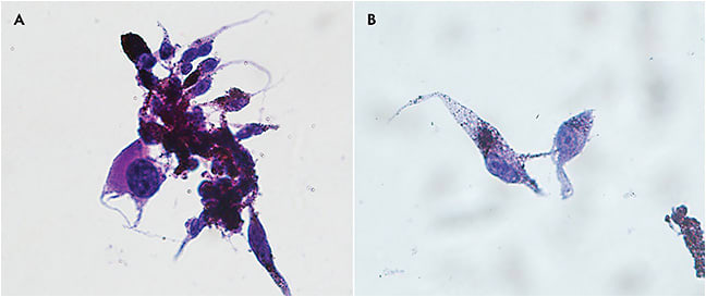 Figure 4. Spindle cells with melanic pigment compatible with uveal melanoma (A). Nuclear detail of melanoma cells with prominent nucleoli (B). Hematoxylin-eosin stain (400x).