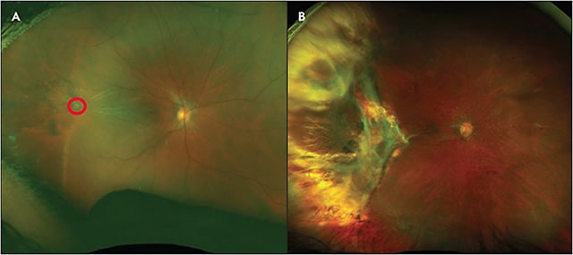 Figure 4. This patient had a retained metallic intraocular foreign body, and the impact site can be seen posteriorly (A; red circle). Due to a contracted edge that developed at the impact site, a scleral buckle was placed, and a temporal retinectomy was performed instead of a circumferential retinotomy (B). The inferior horn of the temporal retinectomy was supported by the scleral buckle. Images courtesy of Lejla Vajzovic, MD.