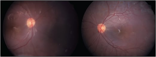 Figure 3. One month following vitrectomy, retinotomy, release of subretinal bands, and silicone oil placement for patient 4, retinal reattachment has occurred in both eyes. The vision initially improved to 20/80 in both eyes but decreased to 20/200 in both eyes during follow-up.
