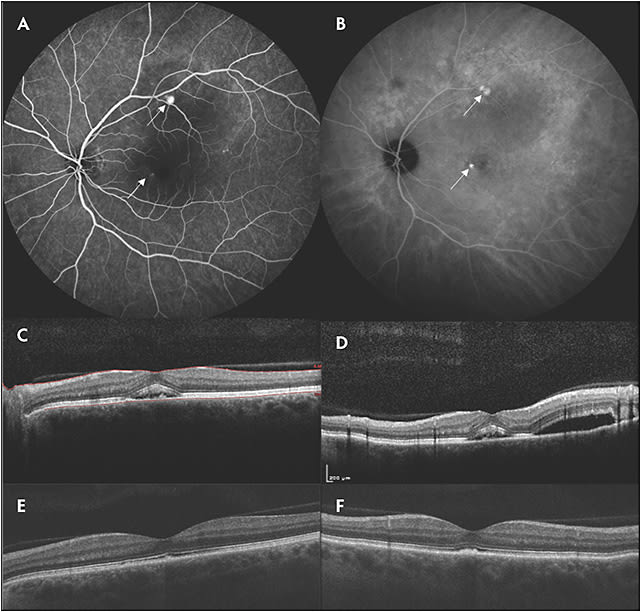 Figure 1. Good response to photodynamic therapy (PDT) in a case of central serous chorioretinopathy. Images of this 46-year-old male patient with blurry vison of 20/25 in the left eye for the prior 4 months show leaks on the juxtafoveal and near-superior arcades on fluorescein angiography (A, arrows) and on indocyanine green angiography (B, arrows). Optical coherence tomography at baseline showing subretinal fluid (SRF) on horizontal (C) and vertical (D) scans. The patient underwent half-fluence PDT and had resolution of symptoms with 20/20 vision at 6 weeks. Optical coherence tomography scans showed no SRF on horizontal (E) and vertical (F) scans.