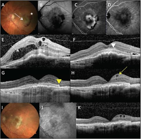 Figure 1. Left eye of a patient with neovascular AMD treated with anti-VEGF injections. At the baseline visit (A to H), visual acuity was 20/50. Color fundus photograph shows choroidal neovascularization (CNV) with hemorrhage at its temporal edge (asterisk; A). Fluorescein angiography demonstrates early leakage characteristic of a classic CNV (B, C). Indocyanine green angiography shows hyperfluorescence corresponding to the location of the CNV (D). Optical coherence tomography (OCT) shows the CNV (E to H); asterisks and arrowheads point at hyperreflective material, while the arrows point at intraretinal fluid. Last follow-up images (I to K) show that following anti-VEGF injections, the fluid has almost resolved. However, fibrosis and atrophy developed, resulting in visual acuity of 20/160.