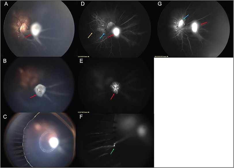 Figure 3. An 8-month-old male with persistent fetal vasculature. Contact fundus photography of the right eye reveals elevation of the optic disc with a fibrovascular stalk extending to the lens (red arrow) (A). Focus on the anterior portion of the stalk shows its vascular nature (B). Elongated ciliary processes are seen (C). Fluorescein angiogram of the right eye demonstrates increased leakage of the fibrovascular stalk (red arrow), staining of the juxtapapillary tissue (blue arrow), and disorganized retinal vessels (orange arrow) (D, G). Fluorescein angiogram reveals the fine vessels in the fibrovascular stalk (red arrow) (E). Elongated ciliary processes with vascular connections to the lens can be visualized with fluorescein (green arrow) (F).