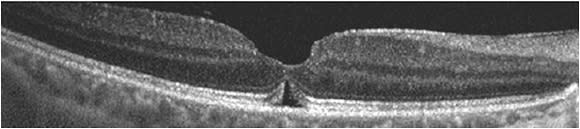 Figure 2. One month after pars plana vitrectomy, internal limiting membrane peel, air-fluid exchange, and gas tamponade for repair of full-thickness macular hole, OCT confirms anatomic closure of the hole along with a subfoveal lucency that is often seen during the early postoperative period and typically not a concern.
Image courtesy of Nitish Mehta, MD
