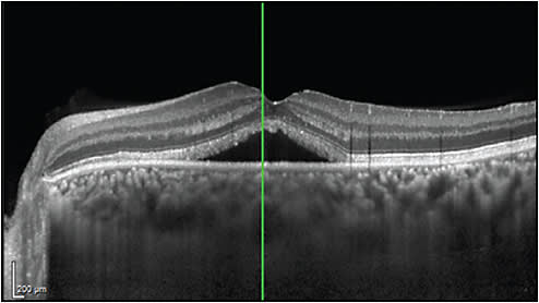 Figure 1. Imaging with EDI-OCT shows CSC with thickened subfoveal choroid with thinning of the inner choroidal layer and underlying hyporeflective choroidal lumina.