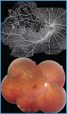 OCTA obtained with Topcon DRI Triton Swept Source OCT
Image courtesy of Professor Yuichiro Ogura, Nagoya City University
