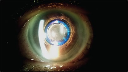 Figure 1.  Clinical image of the Implantable Miniature Telescope (VisionCare, Inc.).
IMAGE COURTESY REY T. PANGILINAN, MD, SOUTHERN CALIFORNIA PERMANENTE GROUP
