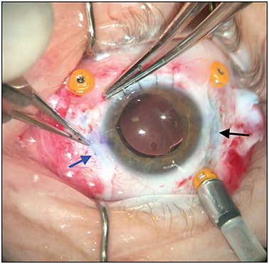 Figure 9. Rotating the knot internally through one of the sclerotomies. This step eliminates the need for a scleral flap. The blue arrow shows the knot just before it is rotated internally. The black arrow shows the other 9-0 prolene with the knot already internalized.