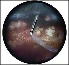 Figure 5. Endoscopic view of a portion of the subretinal membrane prior to extraction through a 23-gauge pars plana trocar.