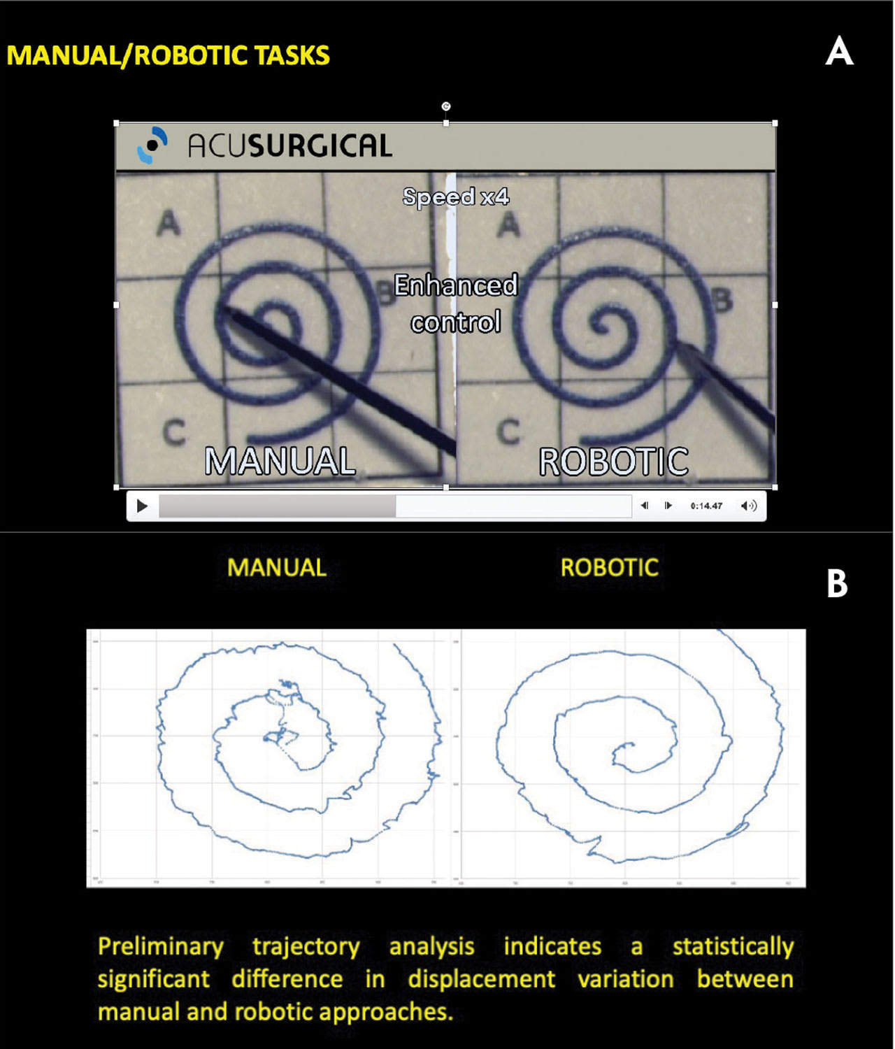 Figure 2. The diameter of a retinal vein is 120 µm, while the human hand has an intrinsic tremor of 200 µm. The Luca system can operate with 20 times less tremor than a human, reported Fanny Nerinckx, MD, enabling greater surgical precision.