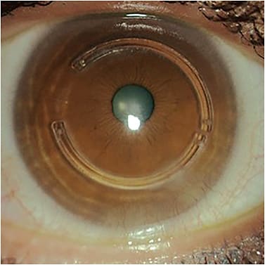 Trouble-shooting the Fit of a Custom Soft Contact Lens