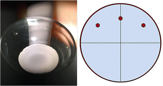 FIGURE 9. Image of fenestrations placed to decrease lens suction and encourage slightly more tear exchange over the superior cornea and the site of most risk beneath the chronic low-hanging lid. Photo courtesy of Sheila Morrison, OD.