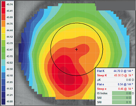 Figure 4. A displaced corneal apex with disease indicators suggesting a normal eye.