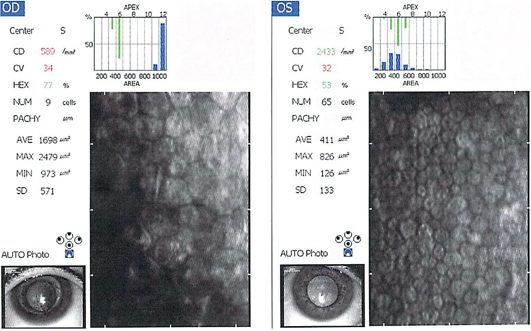 FIGURE 8. Endothelial cell count measured with endothelial cell counter showing a low endothelial cell count of 589 cells/mm2 on the post-PKP right eye and a normal count on the left eye of 2,433 cells/mm2.Image courtesy of Sheila Morrison, OD