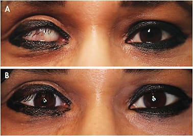 Figure 11. (A) An eye that had a traumatic injury resulting in glaucoma and corneal transplant complications; (B) the same eye with a hand-painted scleral soft stabilized lens.