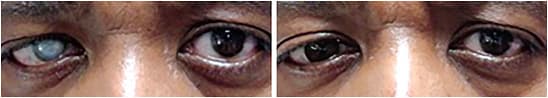 Figure 3. Patient who has phthisis bulbi originally sent for a scleral shell fitting who was a better candidate for a prosthetic contact lens. A solid black lens was the best color match for this dark-eyed patient.