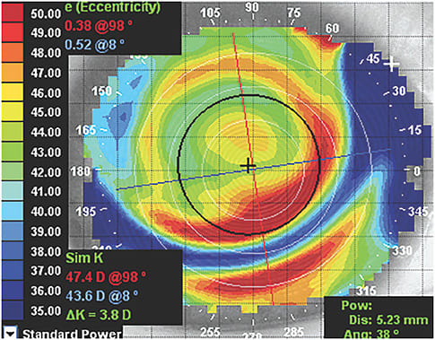 Figure 2. Ortho-k with poor centration.