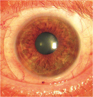 Figure 5. This nasal pinguecula required a custom-designed lens to vault over it without impingement.