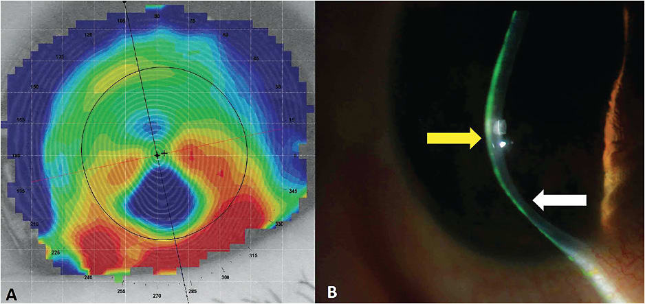 Figure 9. (A) A classic corneal topography of PMD, with (B) the associated slit lamp profile image. The yellow arrow is pointing to the area of ectasia that is superior to the area of marginal thinning (white arrow).