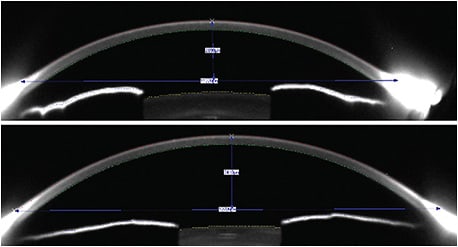 Figure 1. Tomography showing two corneas that have equal keratometry readings but vastly different sagittal depths.