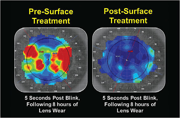 Figure 3. The patient’s tear film quality following eight hours of lens wear pre- and post-surface treatment.