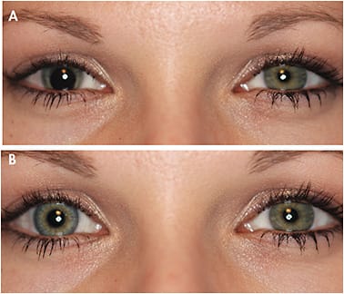 Figure 9. (A) This eye has congenital coloboma causing secondary photophobia; (B) the same eye fit with a hand-painted spherical soft custom lens that has intricate lens coloring.