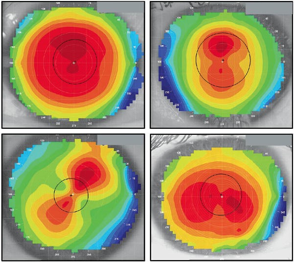 Figure 1. Normal corneal shapes. Upper left: spherical cornea; upper right: with-the-rule astigmatism; lower left: oblique; lower right: against-the-rule astigmatism.