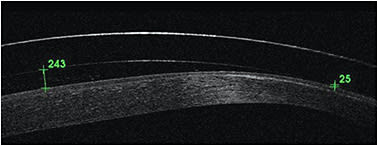 FIGURE 2. A prolate lens showing an optimal central vault while touching the mid-peripheral cornea. Image courtesy of Gregory W. DeNaeyer, OD.