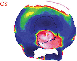 Figure 2. Topographical map of keratoconus OS.