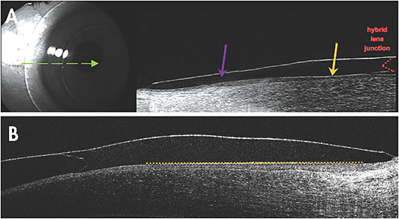 Figure 1. (A) Traditional skirt curve with a landing zone (yellow arrow) and area of curvature (purple arrow); (B) newest hybrid lens skirt technology with a linear landing zone (yellow line) to better align with known linear scleral profile.