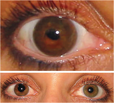 Figure 5. A patient who has an irregular iris (bottom) was being fit with a hand-painted prosthetic contact lens. Although the patient was pleased with the color match between her two eyes, the contact lens positioned inferior temporal and did not align with her natural iris (top). A prism-ballasted design was used for the final lens, and the diameter was increased to 15.0mm to allow for decentration of the prosthetic iris detail.