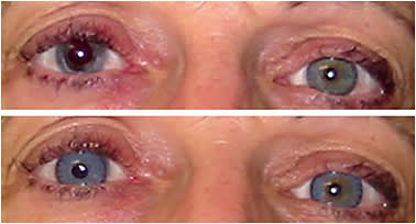 Figure 7. A patient who has light-colored eyes and an irregular right pupil (top). She was fit with a computer-generated prosthetic contact lens for her right eye and a frequent replacement colored lens for vision and color match for her left eye (bottom).