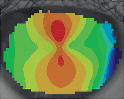 Figure 1. Topographical map of the patient’s right cornea.