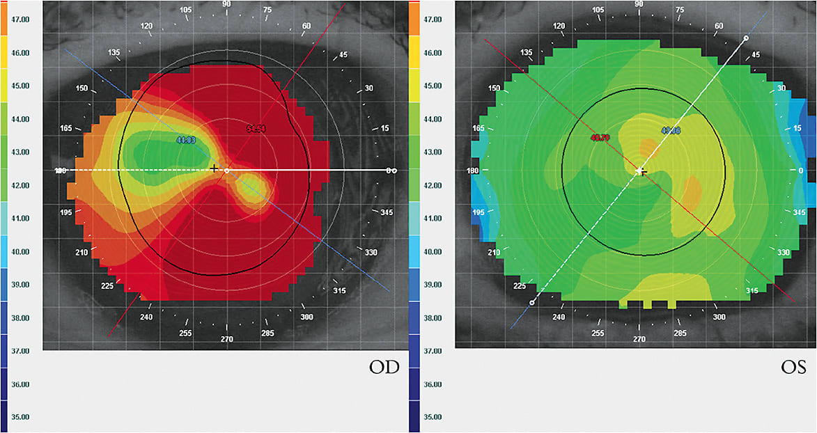 FIGURE 6. Corneal topography showing irregular astigmatism post-PKP OD and mild regular astigmatism OS. Image courtesy of Sheila Morrison, OD