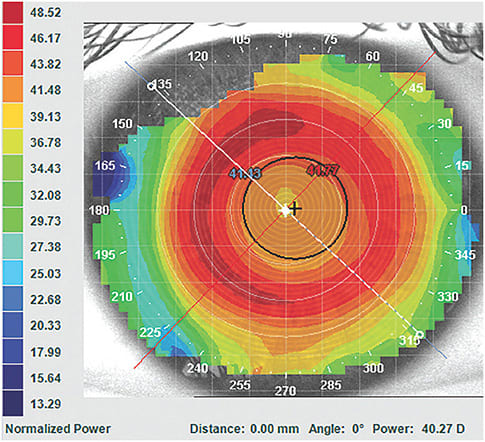 Figure 1. Ortho-k with good centration.