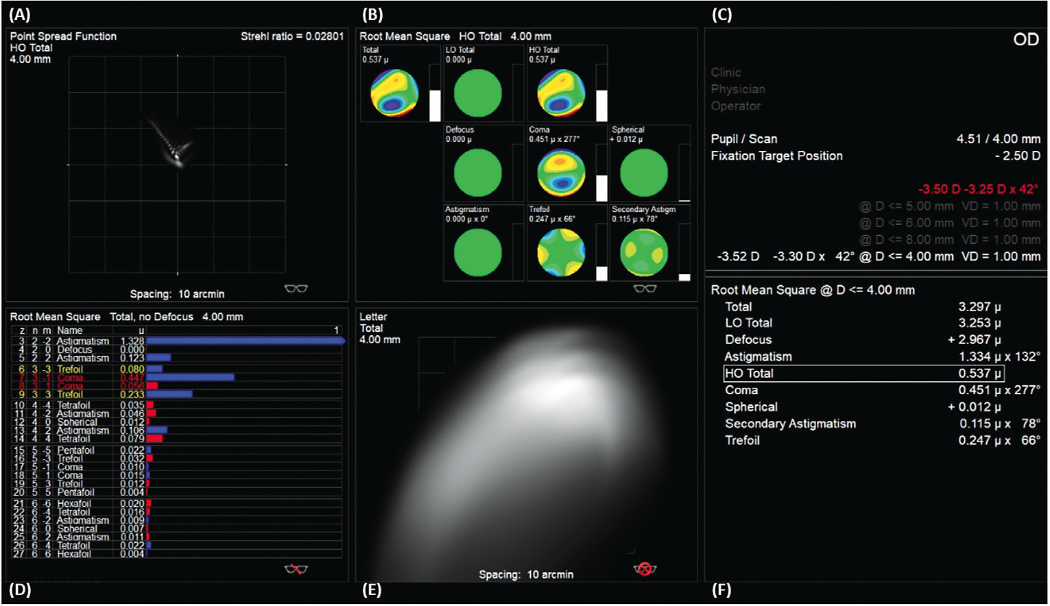 Figure 2. Example of a wavefront aberrometer’s software display illustrating (A) point spread function (PSF), (B) wavefront map displaying total and higher-order aberrations, (C) pupil and scan size, sphere/cylinder refraction, (D) magnitude of each aberration through the sixth order, (E) simulated retinal image of a letter ‘E,’ (F) RMS values for lower- and higher-order aberrations.