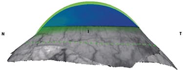 FIGURE 3. An oblate SL fitted on an oblate cornea, showing an optimal central clearance and properly vaulting the mid-peripheral cornea and limbus. Image courtesy of Gregory W. DeNaeyer, OD.