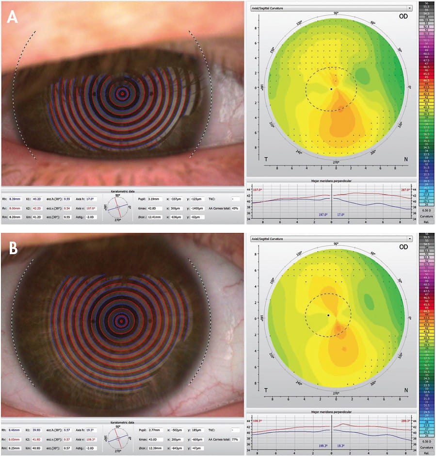 Figure 1. (A) A poor topography map due to lid interference. (B) A well-taken topography map.