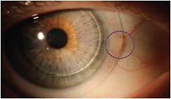 Figure 1. The SiHy skirt of a hybrid lens rests over a nasal pinguecula. A shadow is created highlighting the tenting of the soft skirt over the focal elevation.