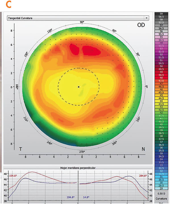 Figure 3. (C) An adjusted ortho-k lens with toric peripheries produced better centration and a more established treatment zone and midperipheral ring.